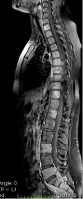 Immagine RM in T1 fat-sat della colonna vertebrale in toto che mostra alterazione di segnale a carico di numerosi corpi vertebrali