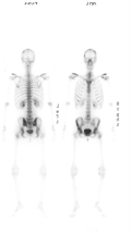 Scintigrafia ossea che mostra l'interessamento osseo diffuso vertebrale, iliaco bilaterale e femorale dx