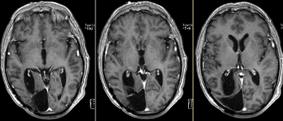 Fig 4: Esame RMN effettuato nel Settembre 2008 dopo trattamento radio e chemioterapico. Le sequenze T1 post-gadolinio mostrano una risposta radiologica completa