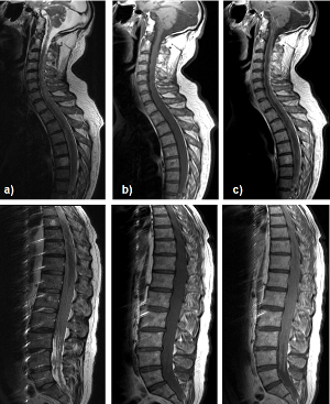 Fig 5: Esame RMN della colonna vertebrale effettuato nell'Ottobre 2008. Le sequenze FLAIR (a), T1 pre (b) e post-contrasto (c) mostrano diffusione della malattia estesa a tutto il canale midollare fino alle radici di L5