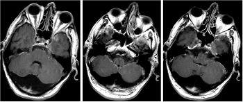 Fig 6: Le immagini RMN T1 post-gadolinio effettuate nell'Ottobre 2008 mostrano diffusione leptomeningea di malattia a livello del basicranio